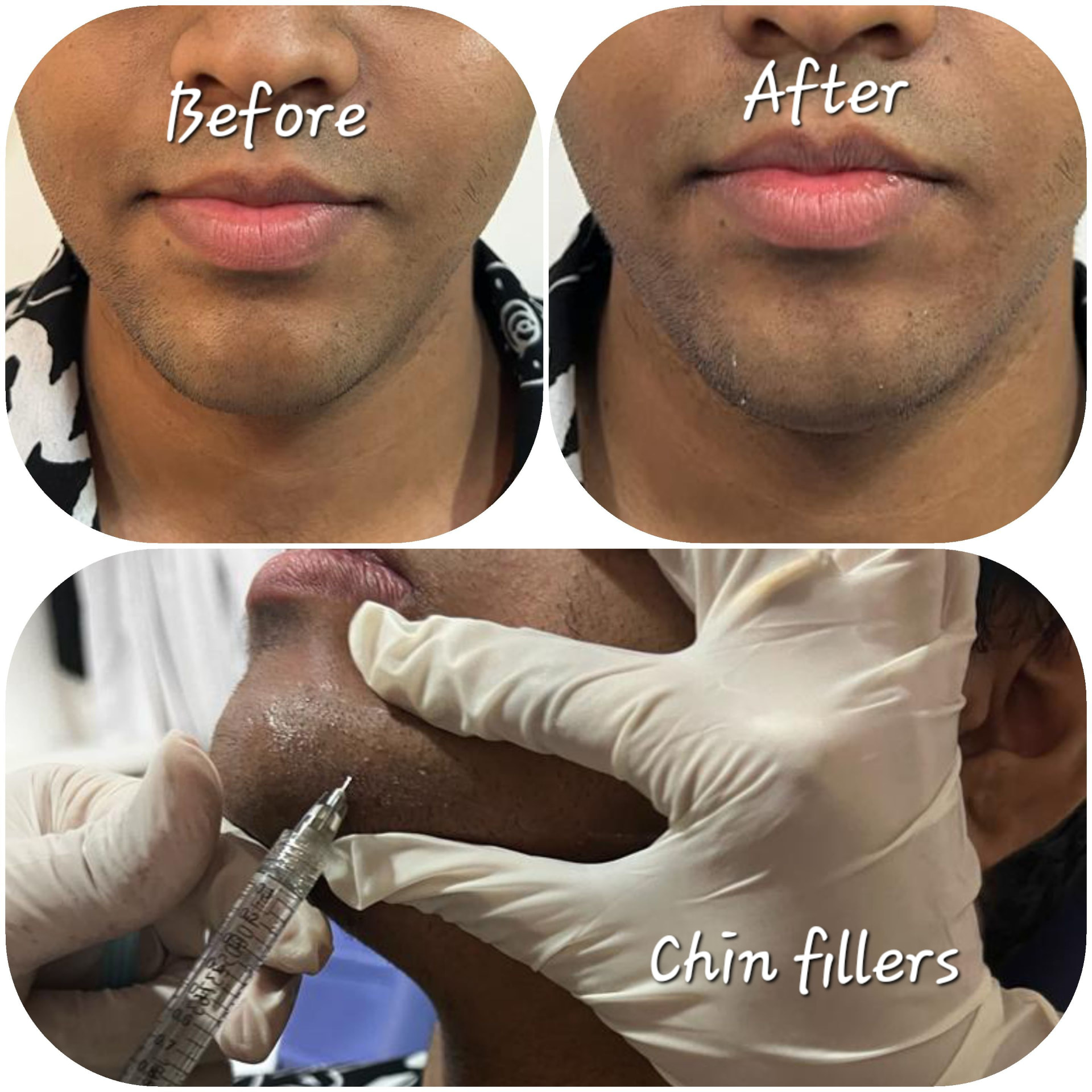 Chin fillers — Before & after
