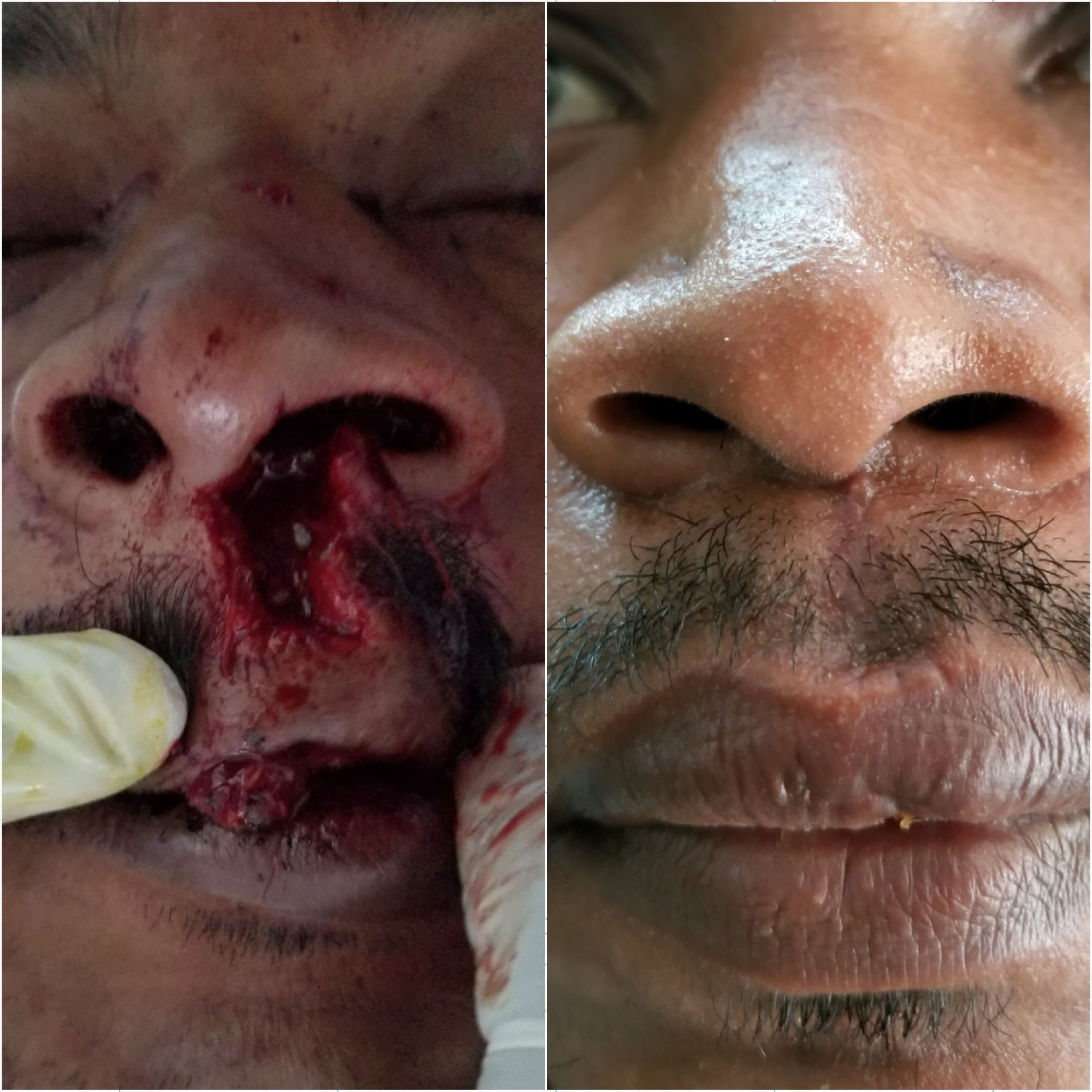 Facial trauma reconstruction — At injury & after healing