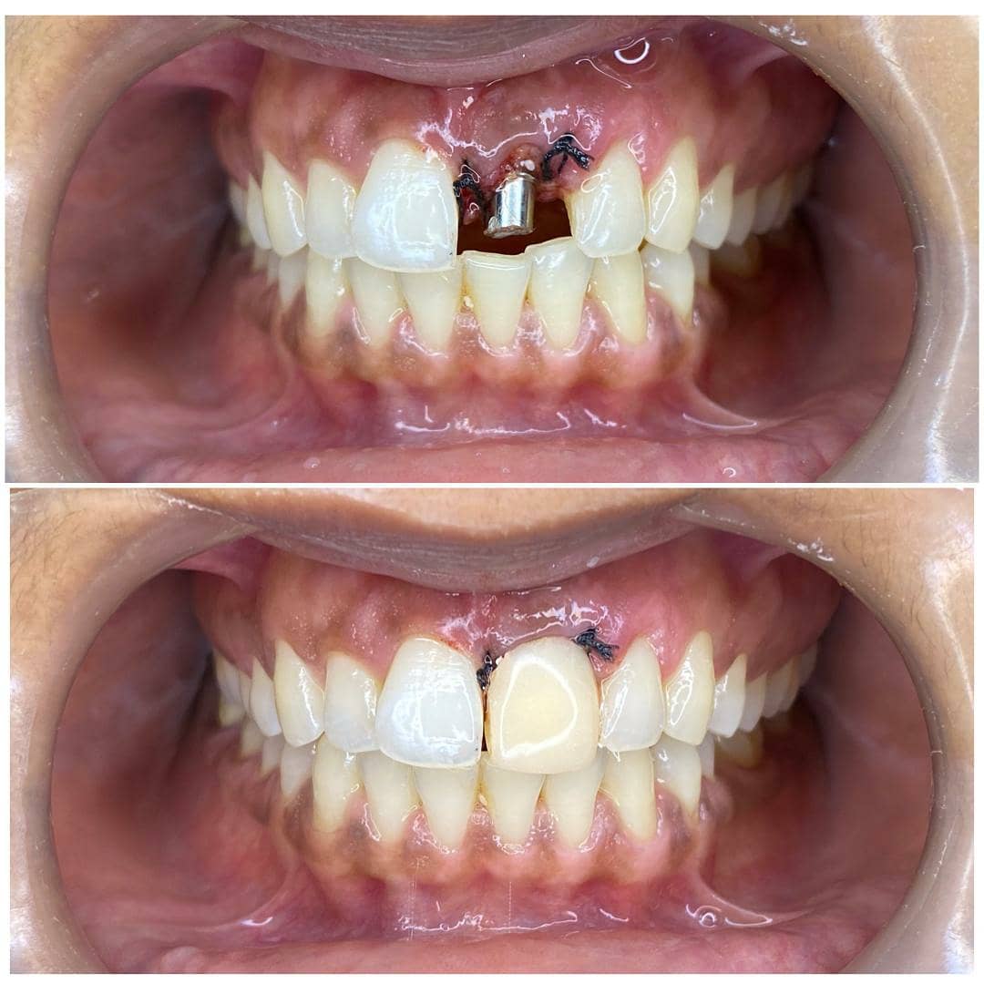Single tooth implant & crown — Before & after