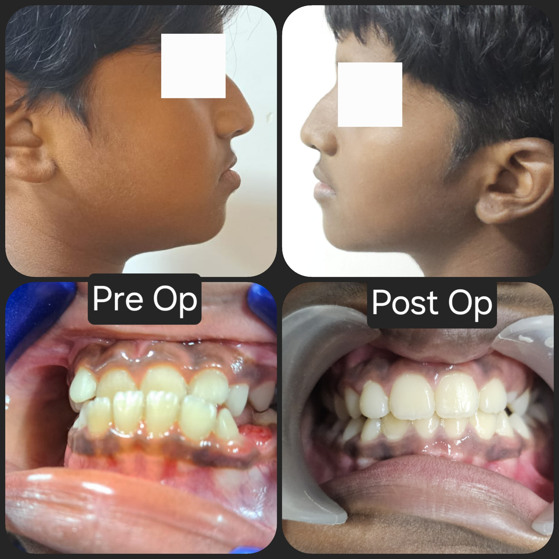 Jaw correction surgery — Pre op & post op